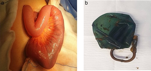 (a) Small bowel loop containing IGB. (b) IGB extracted from the small bowl.