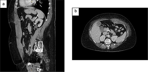 Contrast CT abdomen and pelvis (portal venous phase) demonstrating a left-sided RSH with active extravasation: (a) Sagittal view; (b) Axial view.
