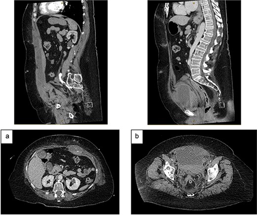 CT angiography (portal venous phase): (a) increased size of RSH and ongoing active extravasation – sagittal (top) and axial (bottom) views. (b) Extraperitoneal haematoma compressing and displacing urinary bladder – sagittal (top) and axial (bottom) views.