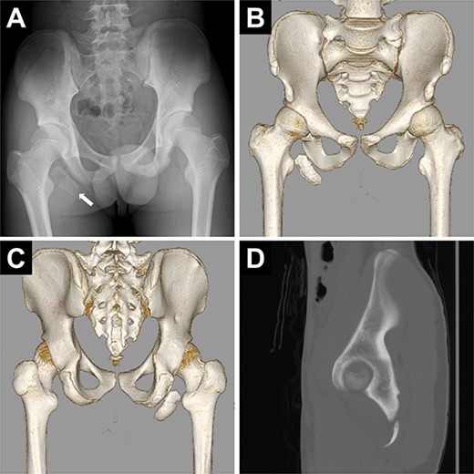 Preoperative images of the pelvis. (A) Pelvic radiograph showing the displaced avulsion fracture of the ischial tuberosity (white arrow). (B, C) Computed tomography scans show the displaced avulsed fragment. The avulsed fragment was displaced by 35 mm. (D) The size of the avulsed fragment was 55 × 17 mm.