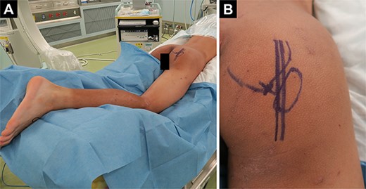 Patient positioning and skin incision. (A) The patient in the prone position with the hip and knee joints in slight flexion after general anesthesia. (B) Longitudinal skin incision 1 cm lateral to the ischilal tuberosity.