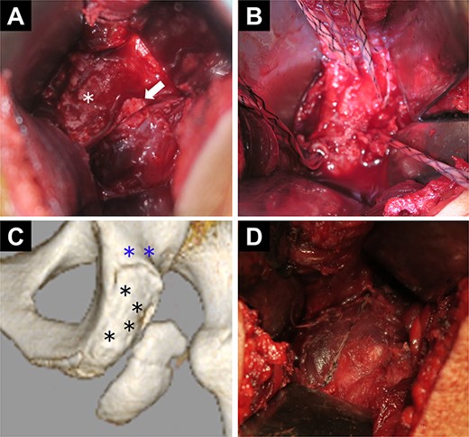 Intraoperative findings and diagram. (A) The avulsed fragment is displaced in the distal direction (white arrow). The asterisk indicates the ischial tuberosity. (B) Four suture anchors at the ischial tuberosity. (C) Diagram with computed tomography images. The blue asterisks indicate the two holes proximal to the ischial tuberosity used to fix the anchor tapes. The black asterisks indicate the four suture anchor holes at the ischial tuberosity. (D) Fixation of the avulsed fragment by suture anchors using the suture bridge technique.