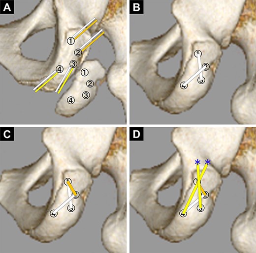 Diagram of the pattern of how to pass the suture tapes. (A) First. Two suture tapes connected to each anchor of the ischilal tuberosity were passed through each of the same number of bone holes in the avulsed fragment. (B) Second. With the avulsed fragment repositioned, the suture tapes No. 1 and No. 3, and No. 2 and No. 4 were tied together to fix the avulsed fragment (white line). (C) Third. The suture tapes No. 1 and No. 2 were tied (orange line). (D) Final. The suture tapes No. 3 and No. 4 were crossed and fixed with absorbable screws (yellow line: suture tape, blue asterisk: absorbable screw to fix the suture tape).