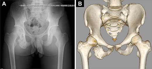 Postoperative images of the pelvis. (A) Plain radiograph. (B) Computed tomography scan.
