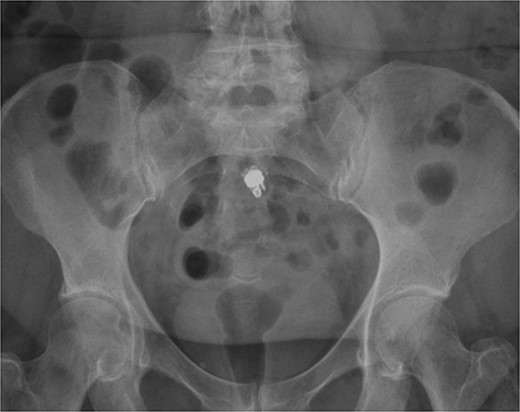 Radiographic appearance of retained capsule in terminal ileum.