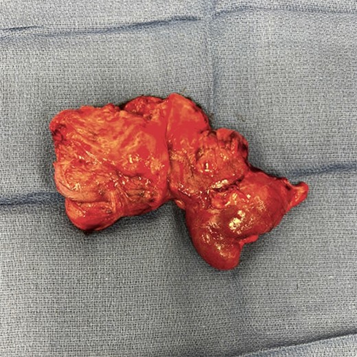 Resected bowel segment.