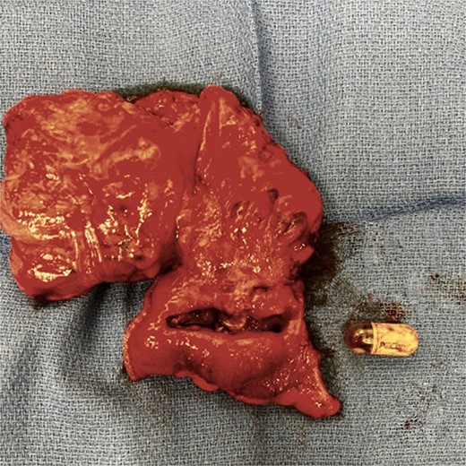 Retained capsule.