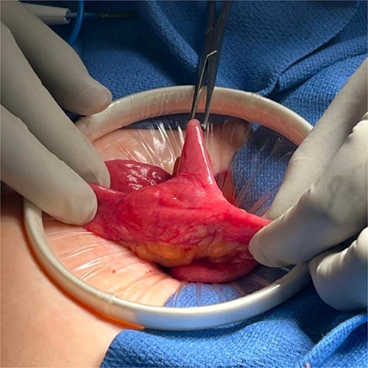 Meckel’s diverticulum.