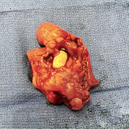 Capsule and Meckel’s.