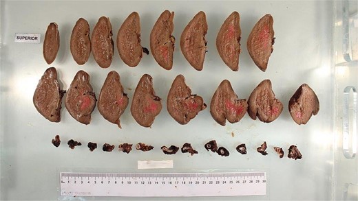 Patient’s spleen and ruptured splenic artery pseudoaneurysm.