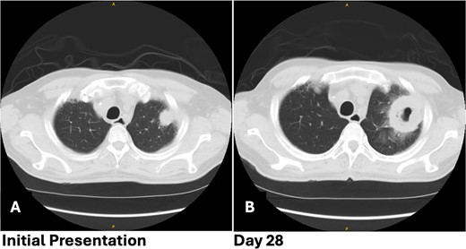 Patient 1 pre-operative images showing rapid progression of disease. (A) Initial CT scan with a 2.4 cm LUL pulmonary nodule. (B) Repeat CT scan 28 days later showing rapid growth and cavitation of the mass, now measuring 7.1 cm.