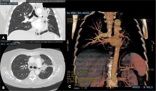 Patient 2 pre-operative images. (A) Coronal section of CT angiogram showing LUL mass abutting the aortic arch and invading the left main pulmonary artery and left mainstem bronchus. (B) Axial CTA showing complete occlusion of the left pulmonary artery. (C) 3D reconstruction of CTA showing complete occlusion of the left pulmonary artery and lack of opacification of any pulmonary artery branches and pulmonary oligemia.