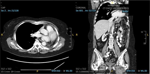 Patient 2 post-operative CT scan showing complete resection of disease and expected post-operative anatomical changes, including leftward deviation of mediastinum and hemidiaphragmatic elevation.