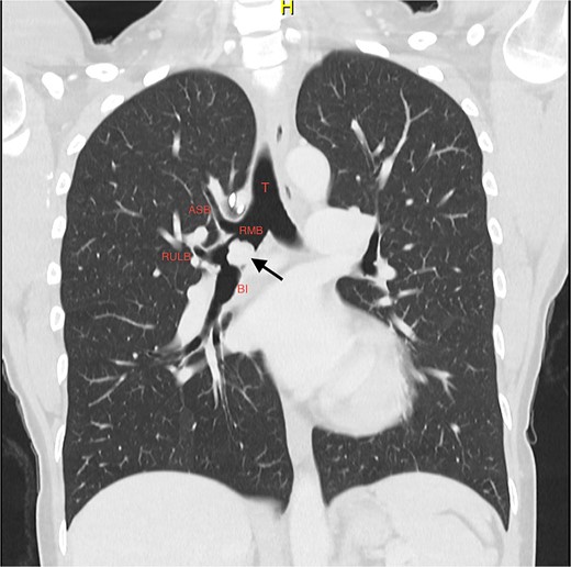 Coronal slice of CT thorax pre-bronchoscopy, showing polypoid tumour arising from the bronchus intermedius and the right upper lobe apical segmental bronchus arising from the RMB at the level of the carina; the arrow is pointing to the tumour; T, trachea; RMB, right main bronchus; ASB, apical segmental bronchus; RULB, right upper lobe bronchus; BI, bronchus intermedius.