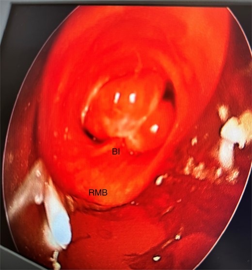 Initial rigid bronchoscopy showing a polypoid mass originating from the membranous portion of the right main bronchus; BI, bronchus intermedius; RMB, right main bronchus.