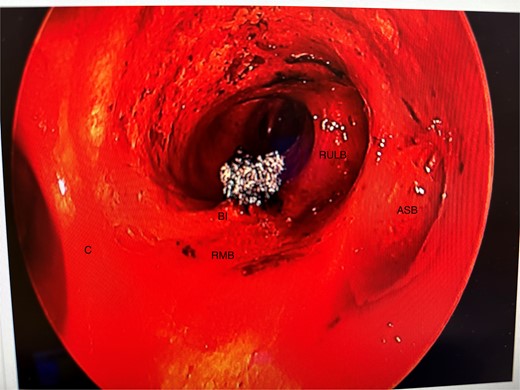 Post disobliteration of the tumour through rigid bronchoscopy, also showing aberrant anatomy, where the apical segmental bronchus of the right upper lobe has a high take off at the distal trachea/carina; C, carina; RMB, right main bronchus; BI bronchus intermedius; RULB, right upper lobe bronchus; ASB, apical segmental bronchus.