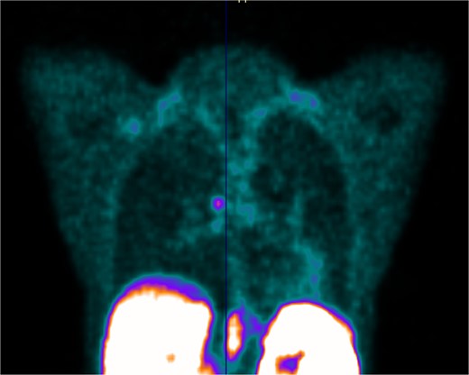 PET scan showing DOTATATE uptake at the level of the right main bronchus; there was no evidence of DOTATATE avid nodal or metastatic disease.