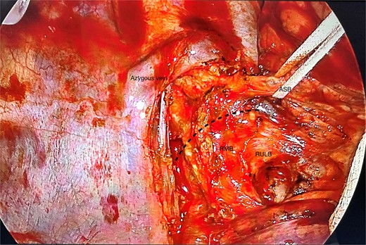 Posterior view of the right main bronchus and branches dissected; the apical segmental bronchus has been slung; ASB, apical segmental bronchus; RULB, right upper lobe bronchus; BI, bronchus intermedius; dotted line = resection line.