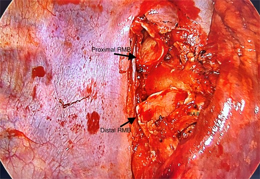 Posterior view of hilum with tumour resected, leaving behind the proximal and distal right main bronchus stumps; RMB, right main bronchus; RULB, right upper lobe bronchus.
