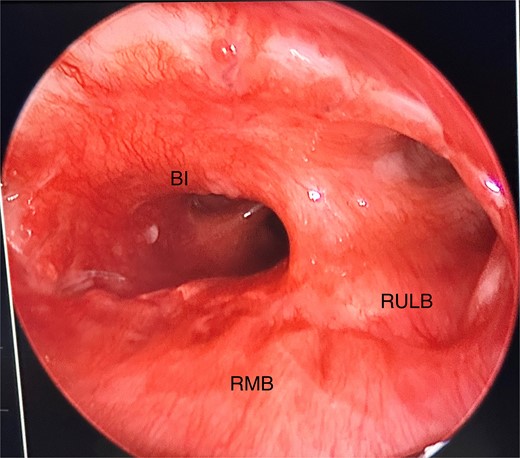 Anastomosis site directly visualized via rigid bronchoscopy, showing good healing and minimal granulation tissue; RMB, right main bronchus; BI, bronchus intermedius; RULB, right upper lobe bronchus.