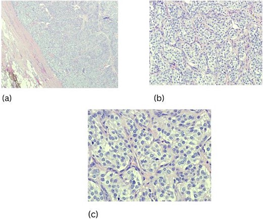 Hemotoxin and Eosin staining, characteristic cellular nests of cells (Zellballen) with surrounding fibrous stroma (a–c).