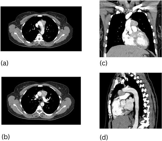 CT scan of the chest, 3.7 cm paraganglioma (a–d).