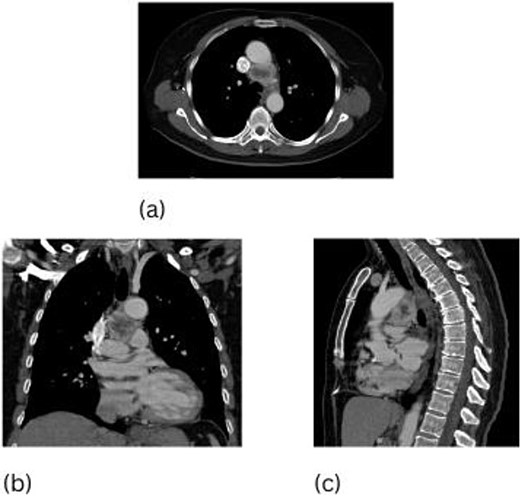 CT scan of the chest, 3.5 cm paraganglioma with necrotic center (a–c).