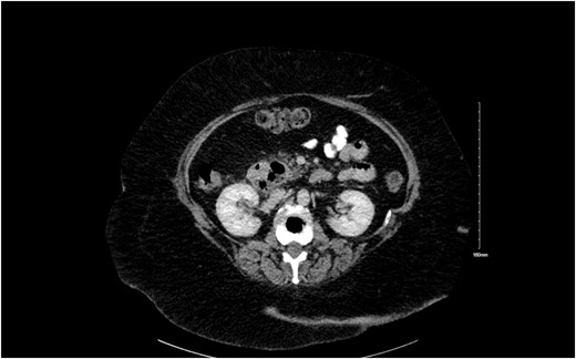 Axial CT view showing a duodenal diverticulum.