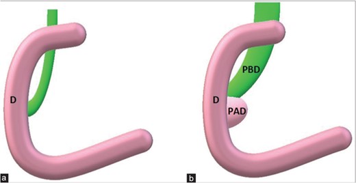 (a) Principal bile duct normally between 4 and 8 mm in maximum diameter. (b) When a periampullary duodenal diverticulum is present, its extrinsic compression could enlarge periampullary duodenal diverticulum till obstructive jaundice.