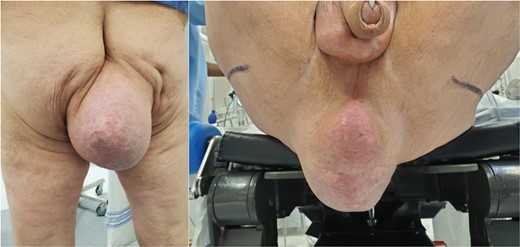 A perianal bulge can be appreciated on this picture. The picture was given with the patient’s consent.