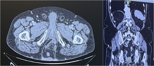 CT scan revealing a PH of 9.5 × 8.7 × 15 cm, containing small bowel.