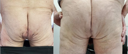 The repaired perineum at 1 month (A) and completely healed wound at 4 months (B).