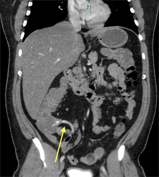 CT-angiogram, late arterial phase. Coronal CT slice showing contrast extravasation into the appendiceal lumen and spillage into the caecum.
