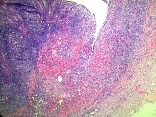 Microscopic view of appendix specimen with small ulceration.