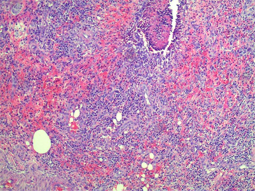 Microscopic zoomed in view of small ulceration measured to be 2 mm.
