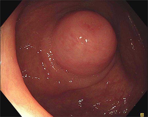 Colonoscopic view of the appendiceal orifice.