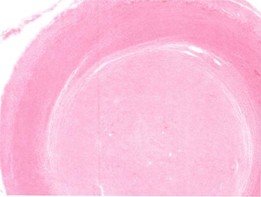 Appendiceal lumen obliterated by neural tumour.