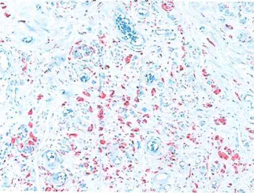 S100 neural marker positive.