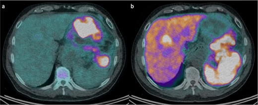 FDG and DOTATATE PET/CT of the mass. (a) Intensely FDG-avid mass with patchy regions of relative photopenia and necrosis. (b) Heterogenic DOTATATE uptake with poor uptake in the FDG avid components at the inferior aspect of the pancreatic mass and superior-posteriorly to the stomach.