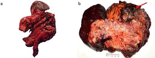 Macroscopic appearance of the tumour. (a) Distal pancreatectomy, splenectomy, partial gastrectomy, and splenic flexure specimen. (b) 190 × 170 mm solid lesion mostly cream and yellow with a hemorrhagic and necrotic nodule (arrow).