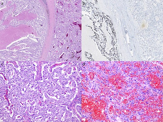 Microscopic appearance of the tumour. (a) Hematoxylin and eosin (H&E) stain at 20× magnification of both the NET (right) and NEC (left) components. (b) Ki-67 immunostain at 20× magnification of both the NET and NEC components. (c) H&E stain at 200× magnification showing well differentiated NET with mild cytological atypia and low mitotic activity. (d) H&E stain at 200× magnification showing NEC with large pleomorphic cells and high mitotic rate.