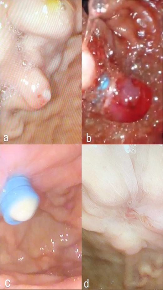 (a) Dieulafoy’s lesion, before ligation. (b) Dieulafoy’s lesion, immediately after ligation. (c) Dieulafoy’s lesion, after ligation. (d) Follow-up upper endoscopy was clear, with no bleeding or ulcers.