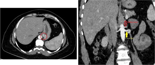(a) Axial CT angio of the abdomen shows a small area of enlarged tortuous blood vessels seen along the posterior cardia of the stomach; these findings are suggestive of Dieulafoy lesion. (b) Coronal abdominal CT images show the feeding blood vessel arising from the descending abdominal aorta located just superior to the origin of the left renal artery.