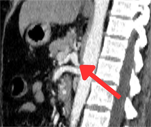 Sagittal abdominal CT angio shows complete obliteration of the celiac trunk due to compression from the medical arcuate ligament.