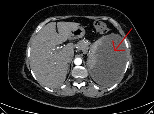 An axial CT scan of the abdomen shows enlarged spleen with almost total liquefaction of splenic parenchyma. Findings are in keeping with splenic infarction.