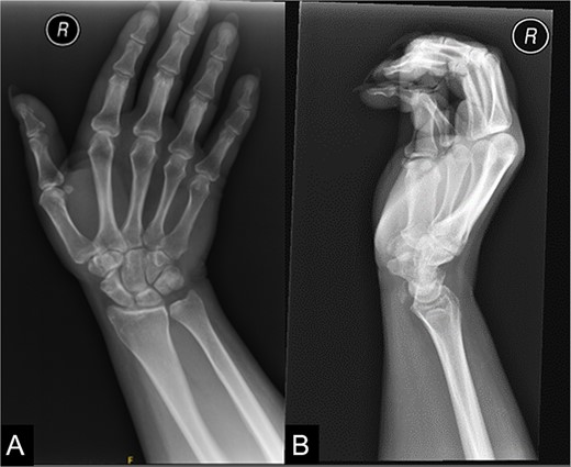 An X-ray of the right wrist which shows calcification at the level of flexor carpi radialis at the wrist.