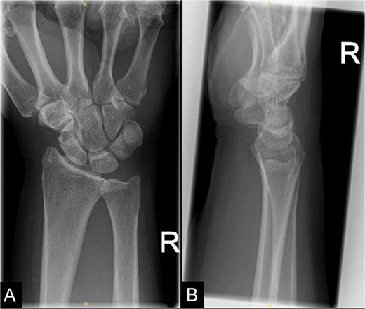 A repeat X-ray of the right wrist indicating that the previous calcific focus at the flexor carpi radialis tendon region had resolved.