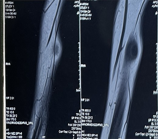 MRI Soft tissue of right forearm: suggestive of well-defined cystic lesion with eccentric mural nodule in intramuscular plane with mild perilesional oedema.