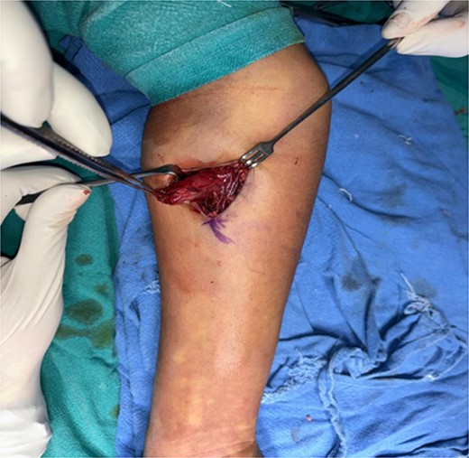 Embedded swelling with in flexor carpi radialis muscle.