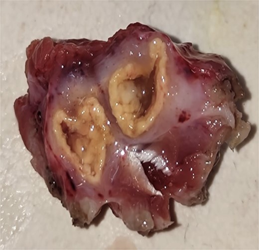 On table, cut section of the specimen showing calcified wall.